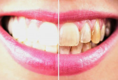 Gigi Rusak Akibat Rokok! Hati-hati Imbasnya Sangat Berbahaya, Simak Penjelasannya 