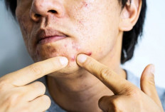 Fakta atau Mitos, Sering Makan Makanan Pedas Penyebab dari Timbulnya Jerawat? Cari Tau Disini!