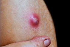 Kenali Penyebab Bisul yang Menganggu dan Cara Pengobatannya Agar Tidak Kembali Lagi!