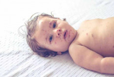 6 Solusi Alami Mengatasi Bekas Cacar yang Efektif, Kembalikan Percaya Dirimu!