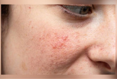 Kulitmu Sering Gatal dan Kering? Waspadai Skin Barrier Rusak, Ini Cara Mudah Mengatasinya!