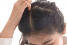 Jangan Panik Masalah Ketombe, Yuk Ikuti 7 Cara Sederhana Ini, Bye Gatal! 