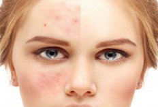 5 Skincare Untuk Mengatasi Bekas Jerawat, Ampuh Bikin Kulit Mulus