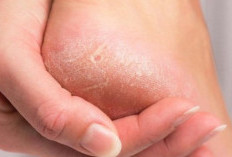 Cara Mengatasi Kaki Pecah-Pecah Secara Alami dan Cepat, Cukup Pakai 2 Jenis Buah!