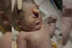 Kelainan Langka Cyclopia, Penyebab Bayi Lahir Bermata Satu, Perlu Tahu Bunda! 