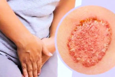 Simak, Cara Sembuhkan Kurap dan Ruam pada Selangkangan, Berikut Penybab dan Pencegahannya!