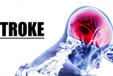 Perhatikan, Berikut ini adalah 7 Tanda-tanda Stroke! Kenali Gejala Awalnya Sangat Penting
