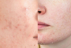 Breakout Parah? Ini Skincare Terbaik dan Paling Aman untuk Pemula 2025