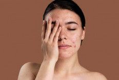 7 Tips Merawat Kulit Wajah Berjerawat Agar Cantik dan Glowing, Yuk Simak Girls!