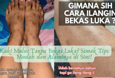 Kaki Mulus Tanpa Bekas Luka? Simak Tips Mudah dan Alaminya di Sini!