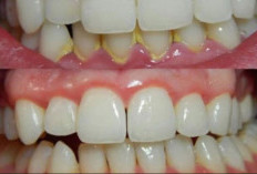 Cara Menghilangkan Karang Gigi Secara Alami dengan Bahan Rumahan Paling Ampuh