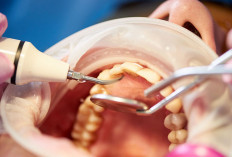 Senyum Sehat Tanpa Beban? 4 Panduan Lengkap Scaling Gigi Gratis dengan BPJS Kesehatan