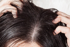 Punya Masalah Ketombe? Kenali Cara Mengatasinya Dengan 8 Bahan Yang Murah Meriah