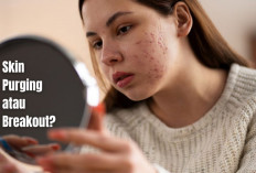 Skin Purging atau Breakout? Ini Cara Bedakan dan Atasi Jerawat Setelah Pakai Skincare Baru