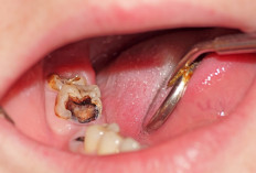 Yuk Simak, 4 Tips Cepat Menyembuhkan Sakit Gigi yang Berlubang, Begini Caranya...