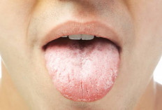 Jangan Anggap Remeh Lidah Putih, Ternyata ini Penyebab dan Cara Mengatasinya