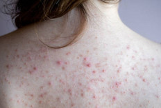 Girls! Ini Jenis-jenis dan Penyebab Munculnya Jerawat Punggung Yang Wajib Kamu Tau, Apa Aja?