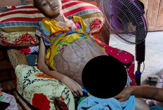 Di Balik Seragam yang Tergantung, Nopal Penderita Tumor Menanti Kesempatan Sembuh