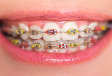 Gigi Berantakan Udah Gak Jaman Lagi! Berikut 10 Manfaat Pemasangan Behel agar Senyum Kalian Berseri