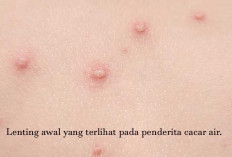 Perawatan Pasien Cacar Air di Rumah, dan 4 Kiat Mencegah Penularan 