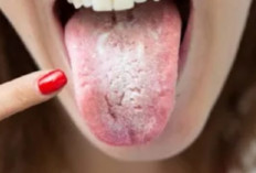 Jangan Abai! Kenali 4 Gejala Kanker Mulut Berikut ini, Jangan Anggap Sepele