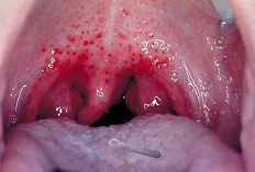 Radang Tenggorokan yang Tak Kunjung Sembuh, Bisa Jadi Tanda Penyakit Autoimun