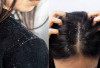 Cara Ampuh Merawat Rambut Berketombe di Rumah: Praktis, Alami, dan Terbukti Efektif!