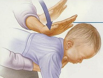 Serem! Tersedak Bisa Berdampak Kematian, Begini Cara Terbaik Menanganinya