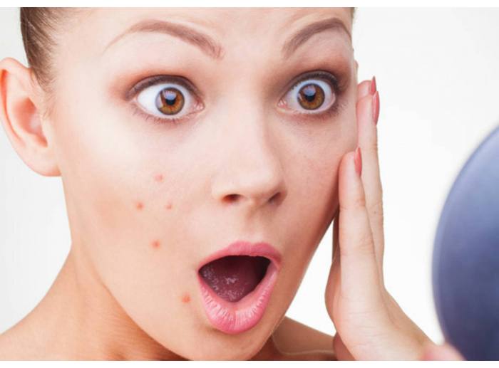 Musim Panas Bikin Jerawat Kamu Lebih Banyak? Tenang Ngga Perlu Khawatir, Ikutin 3 Tips Ini Yuk