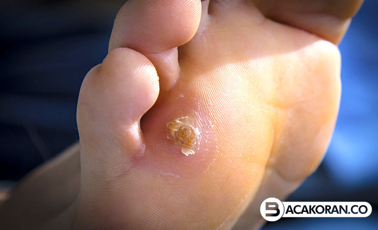 Penyakit Mata Ikan: Penyebab, Tanda, dan Metode Pengobatan yang Efektif